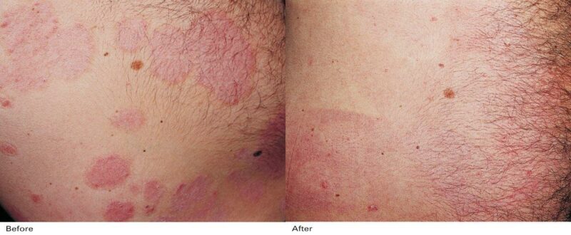 Rezultate Inainte si dupa laser Psoriasis & Vitiligo DEKA
