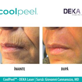 rezultat CooPeel - Rejuvenare Facială - Peeling Laser CO2