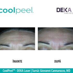 rezultat CooPeel - Rejuvenare Facială - Peeling Laser CO2