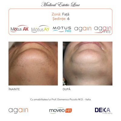 rezultate inainte si dupa epilare cu DEKA Laser Alexandrite 1