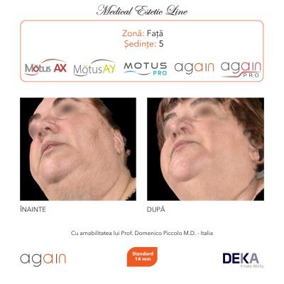 rezultate inainte si dupa epilare cu DEKA Laser Alexandrite 10