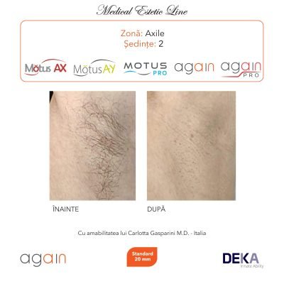 rezultate inainte si dupa epilare cu DEKA Laser Alexandrite 13