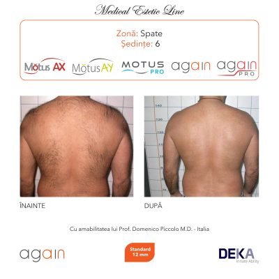 rezultate inainte si dupa epilare cu DEKA Laser Alexandrite 15