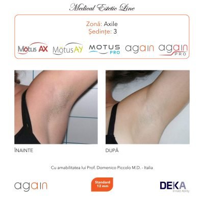 rezultate inainte si dupa epilare cu DEKA Laser Alexandrite 16