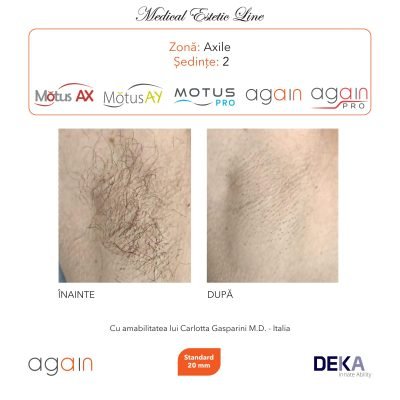 rezultate inainte si dupa epilare cu DEKA Laser Alexandrite 17