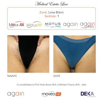 rezultate inainte si dupa epilare cu DEKA Laser Alexandrite 2