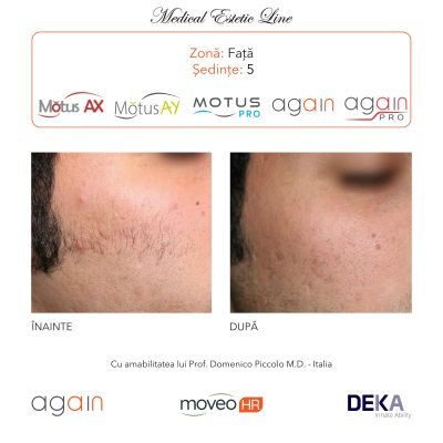rezultate inainte si dupa epilare cu DEKA Laser Alexandrite 3