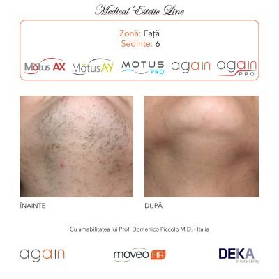 rezultate inainte si dupa epilare cu DEKA Laser Alexandrite 4