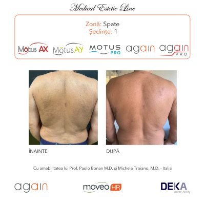 rezultate inainte si dupa epilare cu DEKA Laser Alexandrite 5