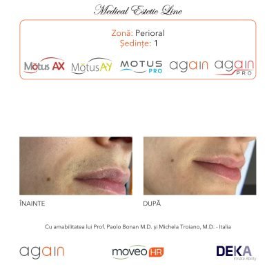 rezultate inainte si dupa epilare cu DEKA Laser Alexandrite 6