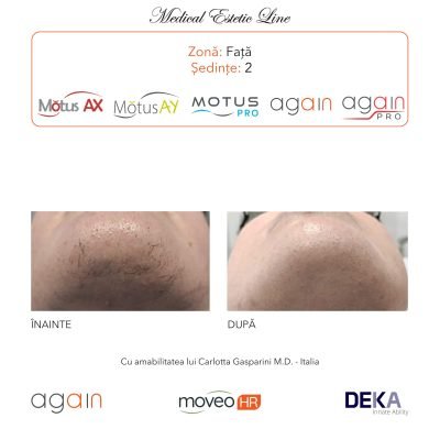 rezultate inainte si dupa epilare cu DEKA Laser Alexandrite 9